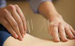 Close-up of hands gently placing acupuncture needles during a treatment at The Acupuncture Center in Nyack, NY.